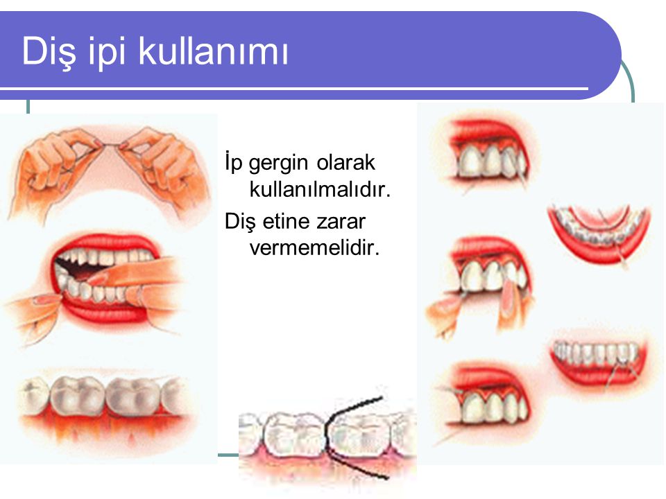 Diş ipi kullanımı İp gergin olarak kullanılmalıdır.