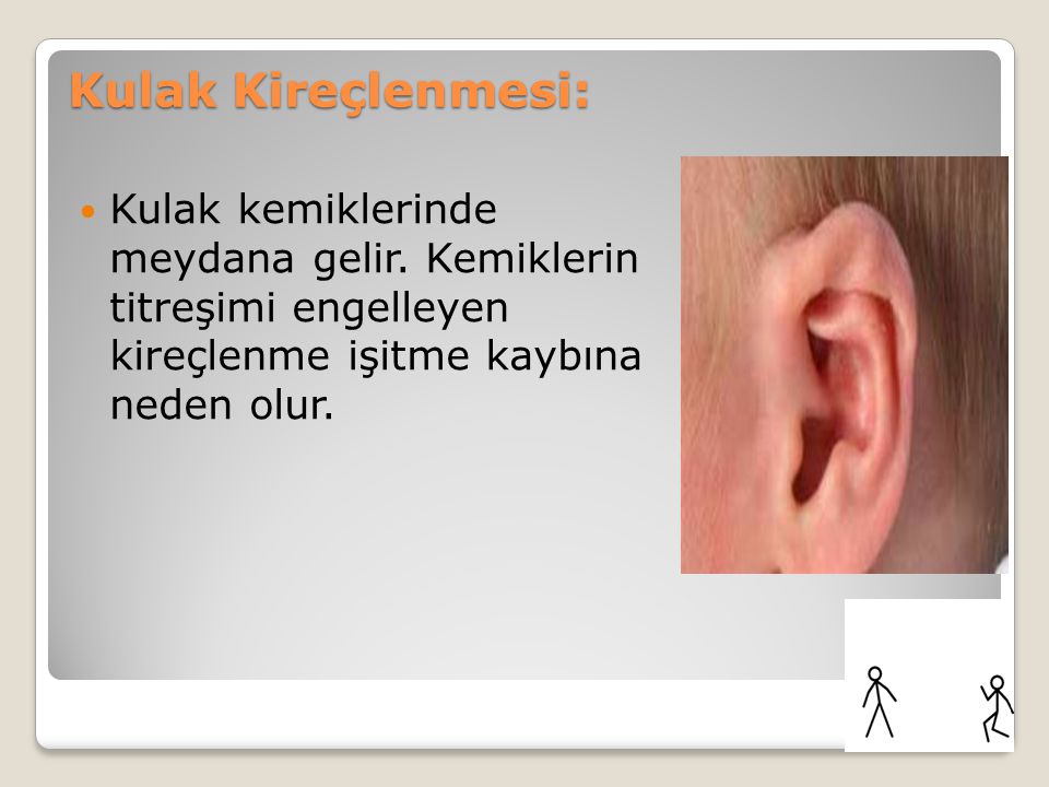 Kulak Kireçlenmesi: Kulak kemiklerinde meydana gelir.