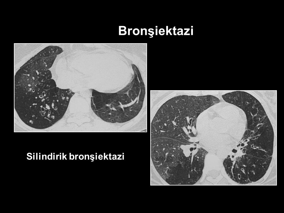 Bronşiektazi Silindirik bronşiektazi