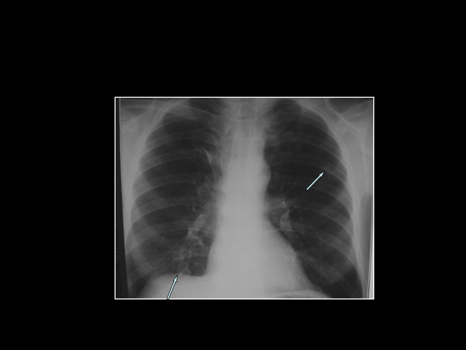 PA Akciğer ve Lateral Grafi
