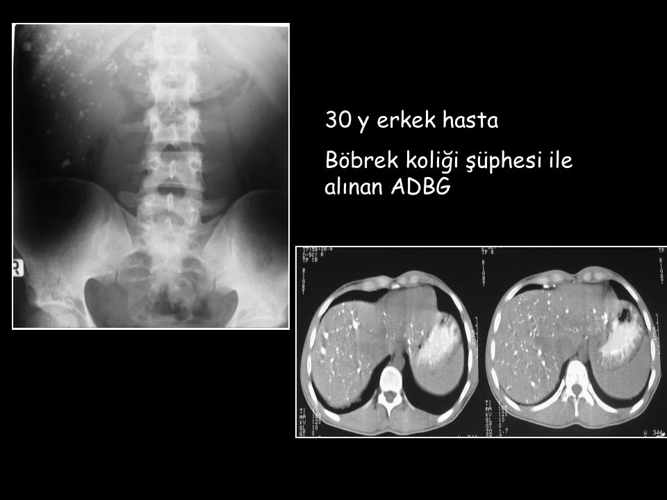 30 y erkek hasta Böbrek koliği şüphesi ile alınan ADBG