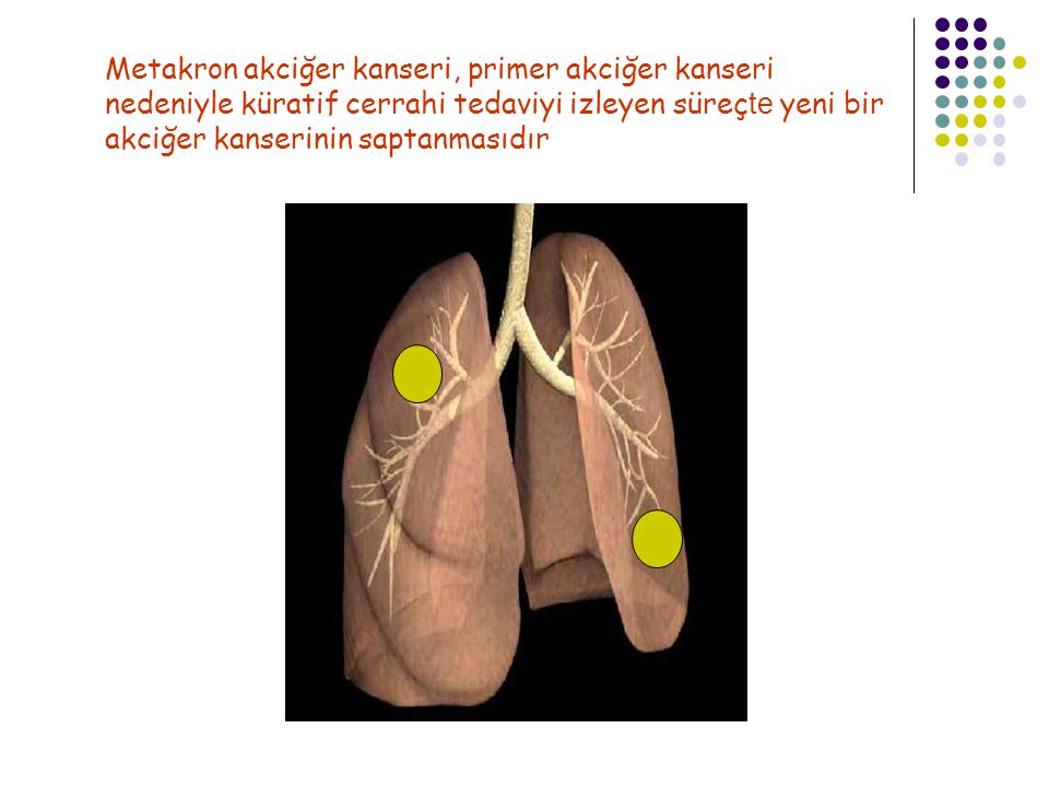Metakron akciğer kanseri, primer akciğer kanseri nedeniyle küratif cerrahi tedaviyi izleyen süreçte yeni bir akciğer kanserinin saptanmasıdır