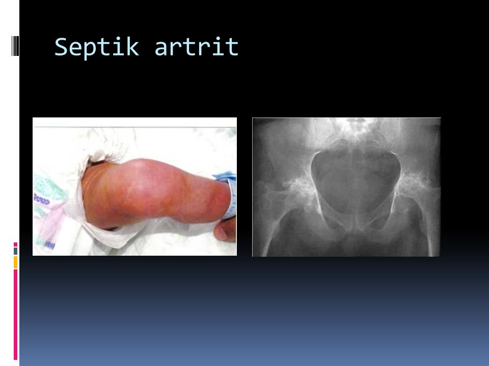 Septik artrit