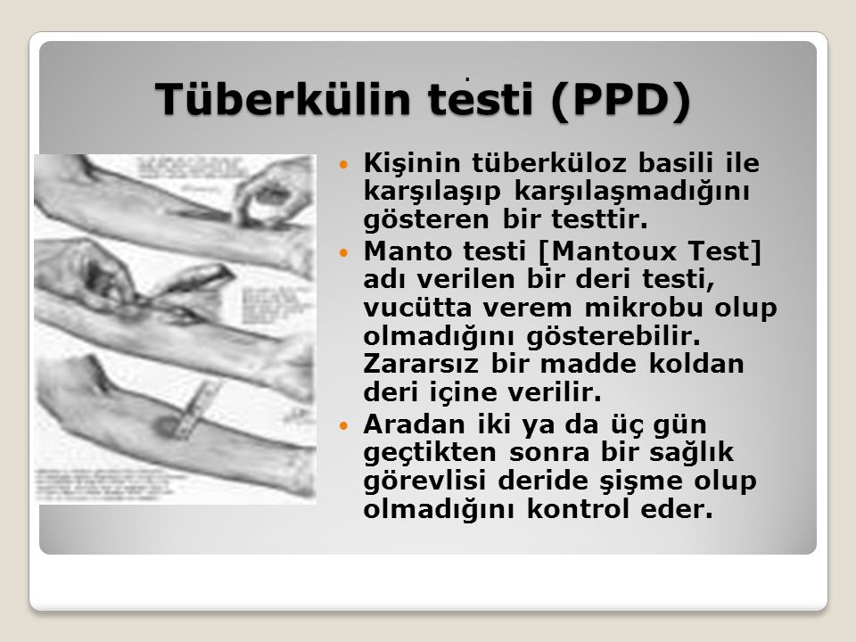 Tüberkülin testi (PPD)