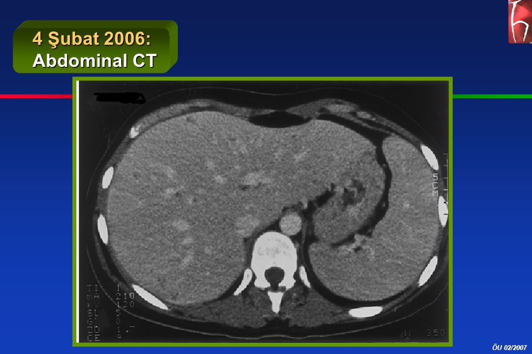 4 Şubat 2006: Abdominal CT C. Akman: CT görünümünün yorumu