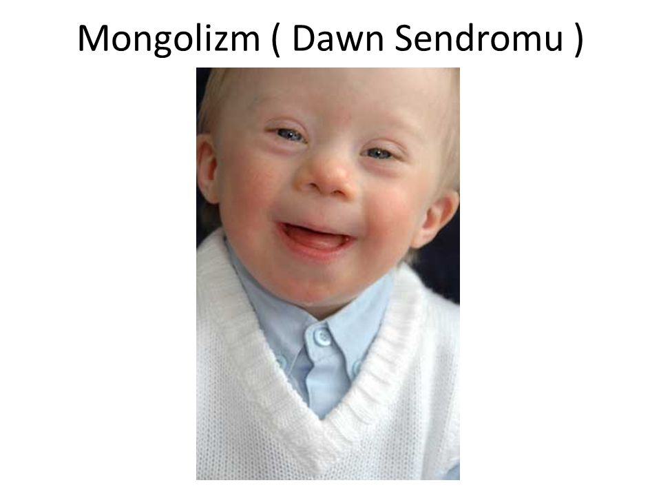 Mongolizm ( Dawn Sendromu )