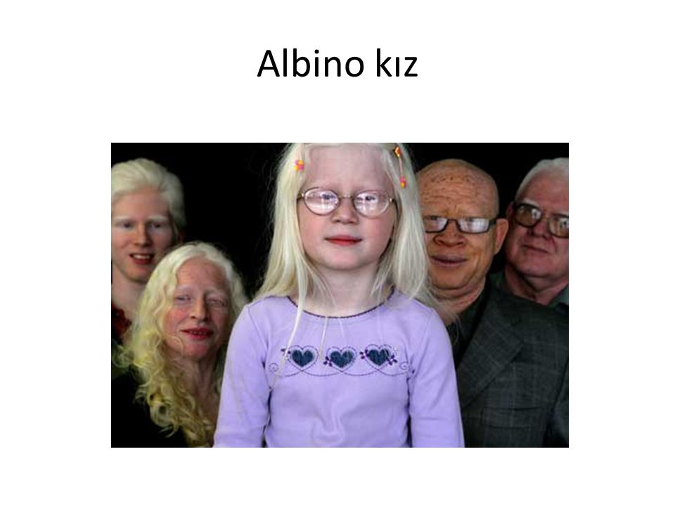 Albino kız