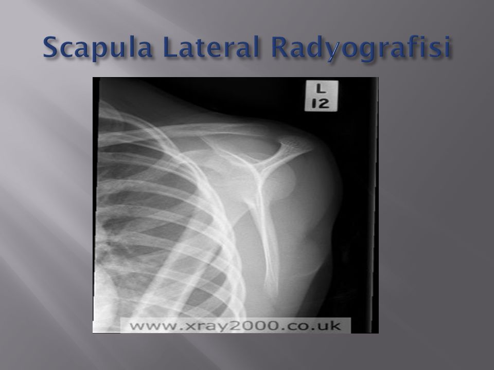 Scapula Lateral Radyografisi