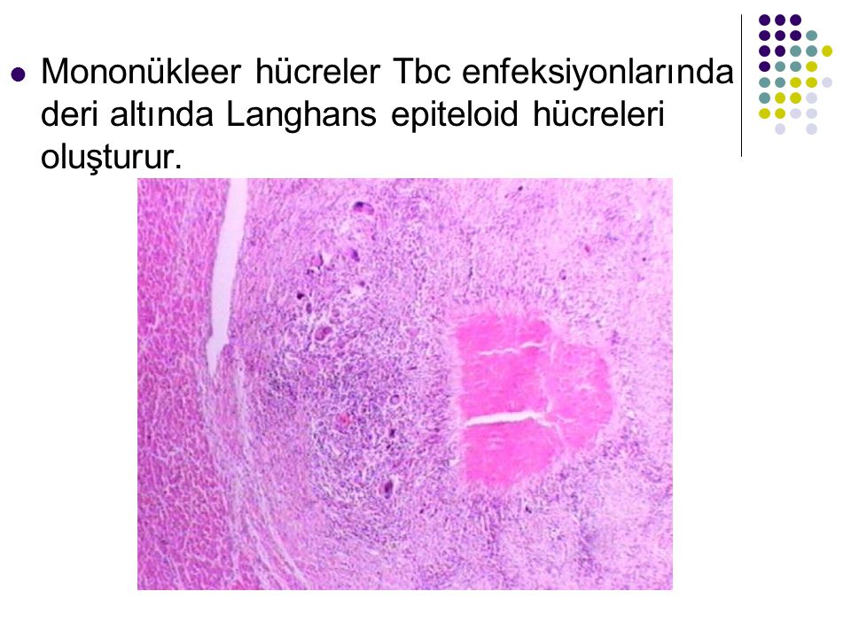 Mononükleer hücreler Tbc enfeksiyonlarında deri altında Langhans epiteloid hücreleri oluşturur.