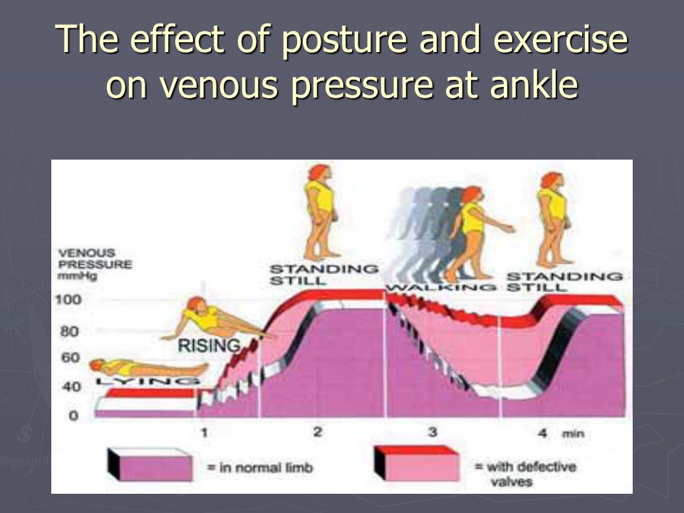 The effect of posture and exercise on venous pressure at ankle