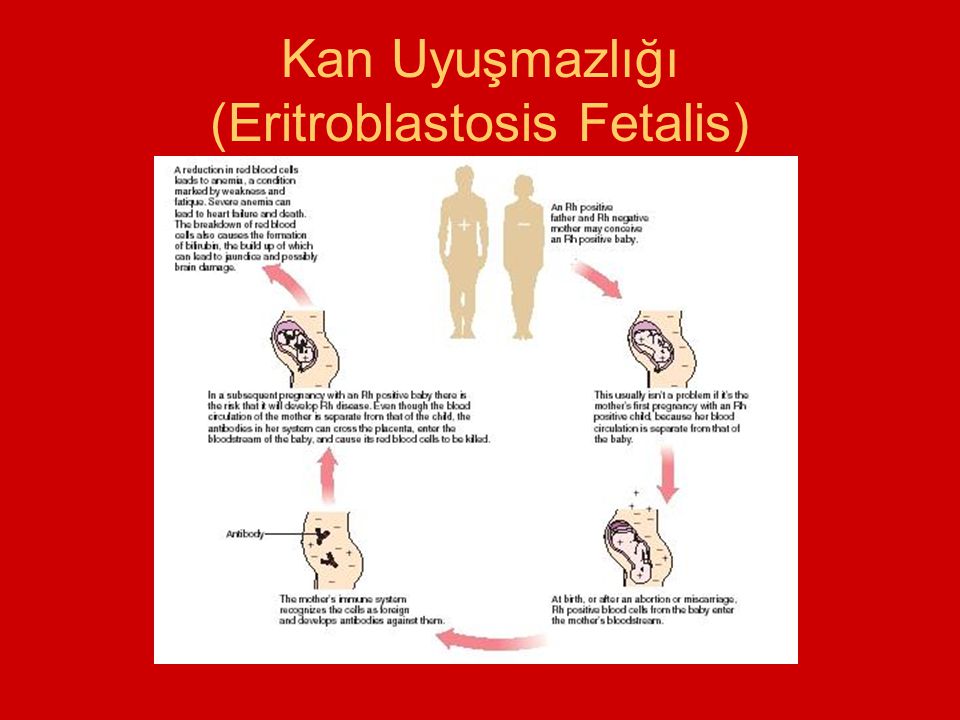 Kan Uyuşmazlığı (Eritroblastosis Fetalis)