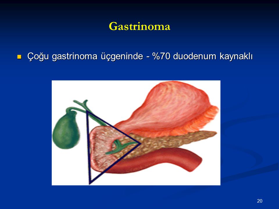 Gastrinoma Çoğu gastrinoma üçgeninde - %70 duodenum kaynaklı