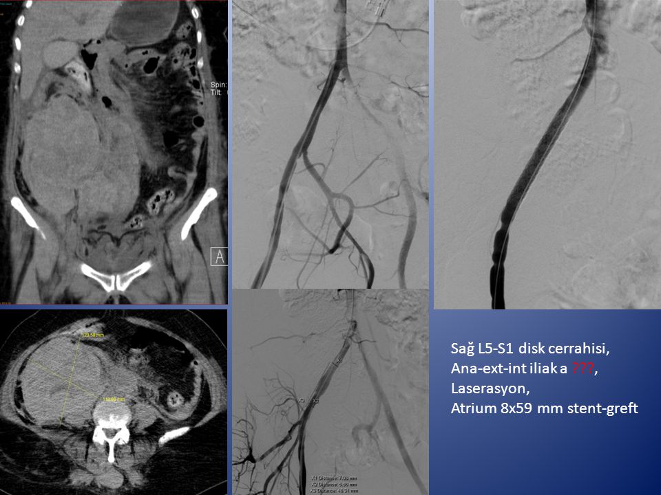 Sağ L5-S1 disk cerrahisi, Ana-ext-int iliak a , Laserasyon, Atrium 8x59 mm stent-greft