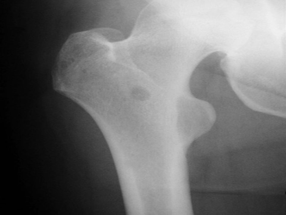 Radiograph of the right femur