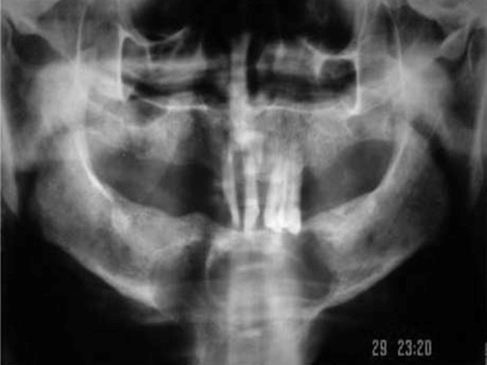 Panoramic radiograph – radiolucent lesions in the symphysis, body and mandibular limb.
