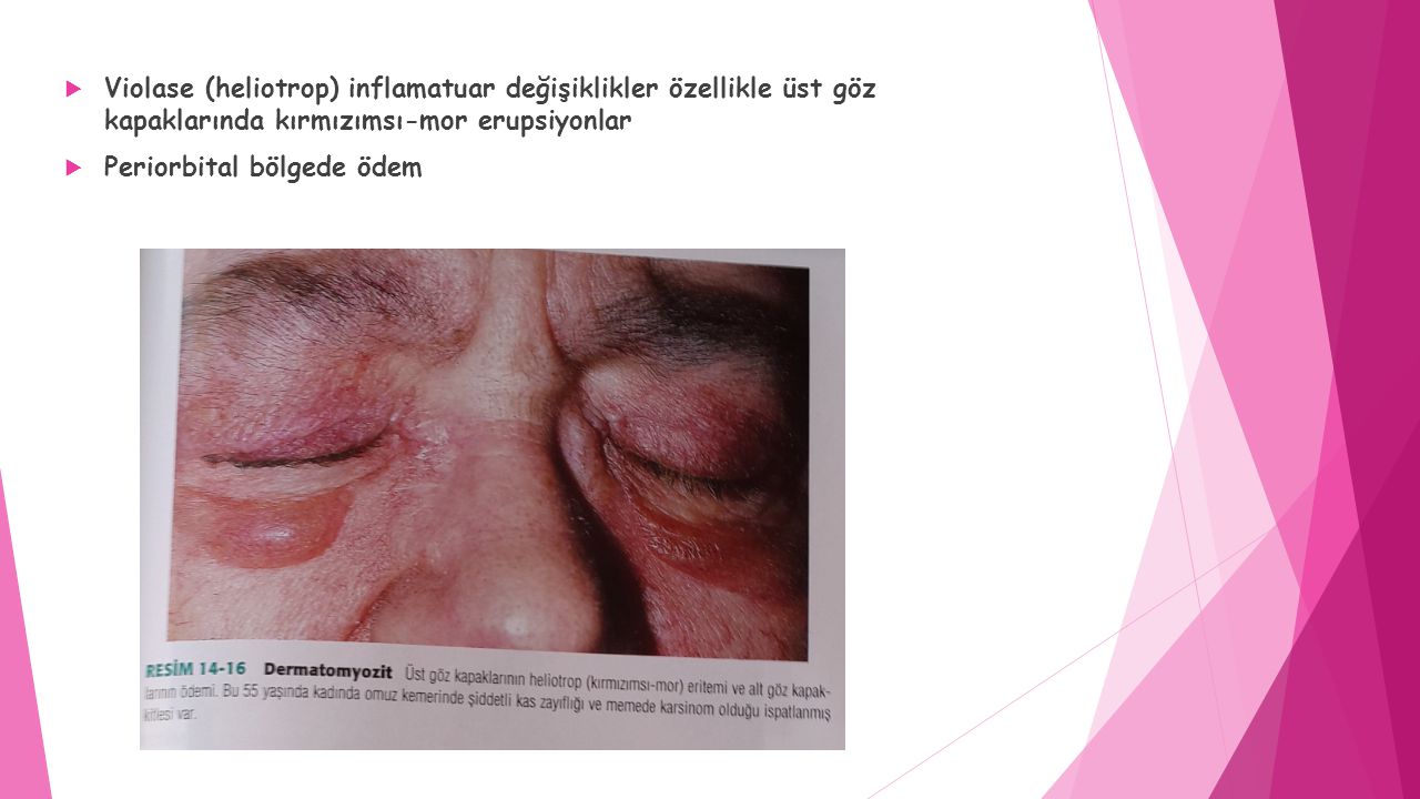 Violase (heliotrop) inflamatuar değişiklikler özellikle üst göz kapaklarında kırmızımsı-mor erupsiyonlar