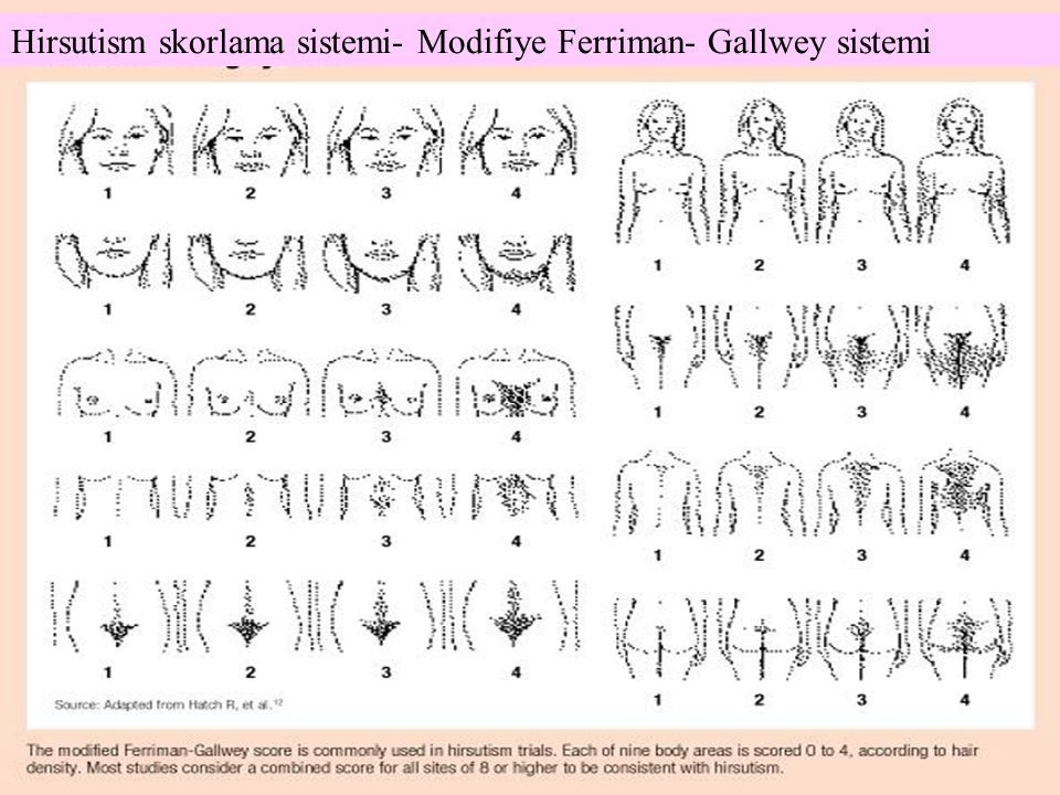 Hirsutism skorlama sistemi- Modifiye Ferriman- Gallwey sistemi