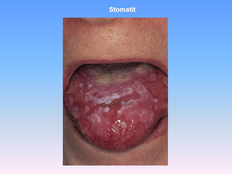 Stomatit