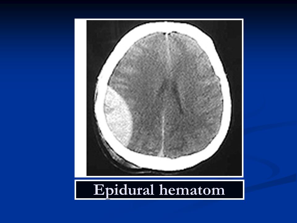 Hominick Hematoma