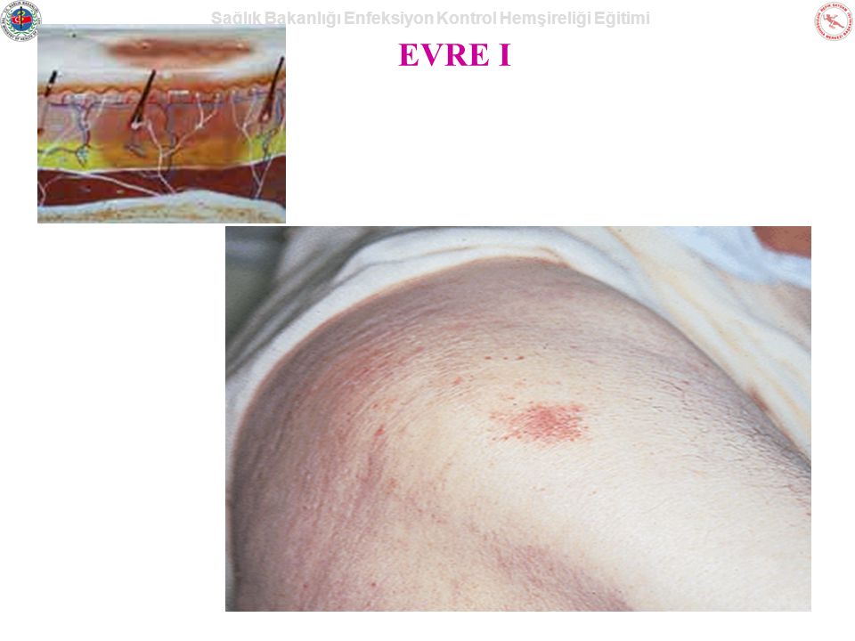 EVRE I This is an example of a Stage I Pressure Ulcer on darkly pigmented skin. It could need to be palpated for induration, warmth and/or edema.