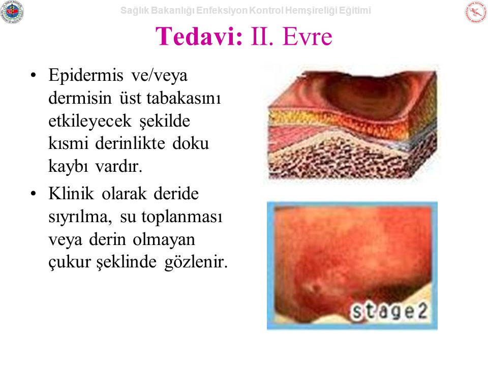 Tedavi: II. Evre Epidermis ve/veya dermisin üst tabakasını etkileyecek şekilde kısmi derinlikte doku kaybı vardır.