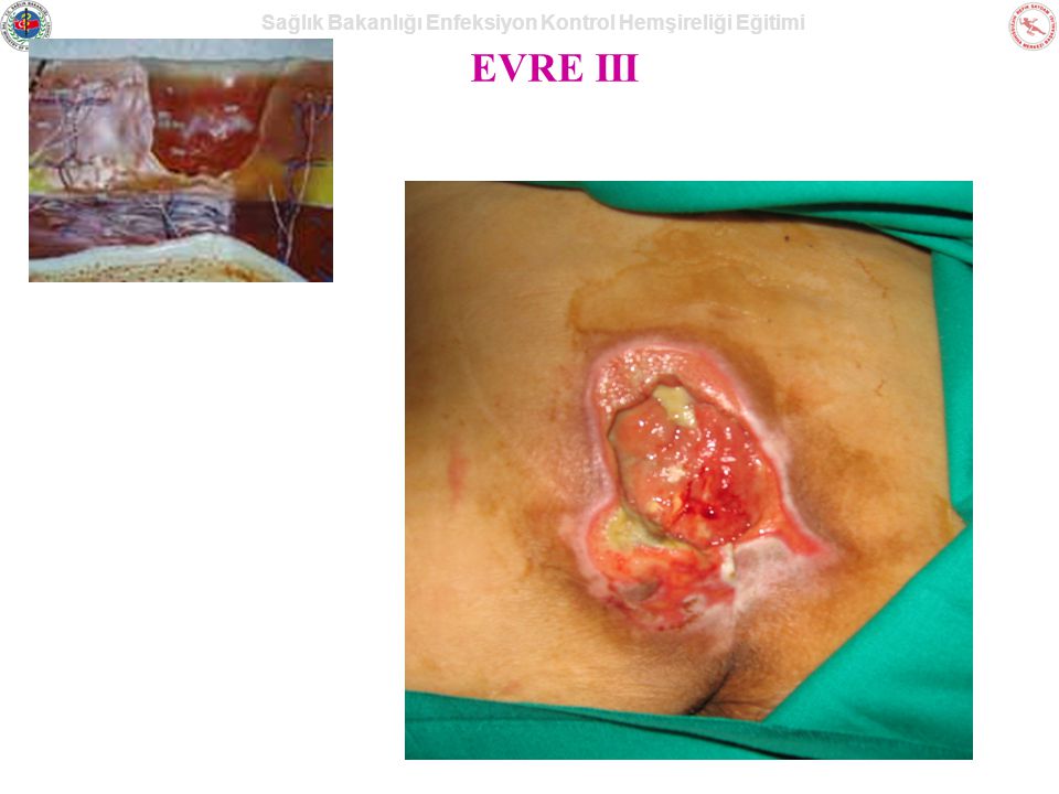 EVRE III This slide is a stage III pressure ulcer on the left trochanter.