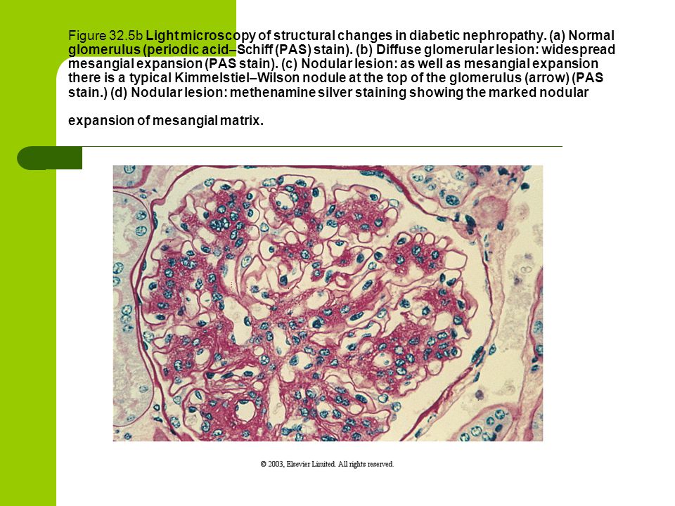 Figure 32.5b Light microscopy of structural changes in diabetic nephropathy.