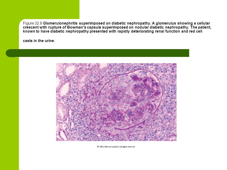 Figure Glomerulonephritis superimposed on diabetic nephropathy