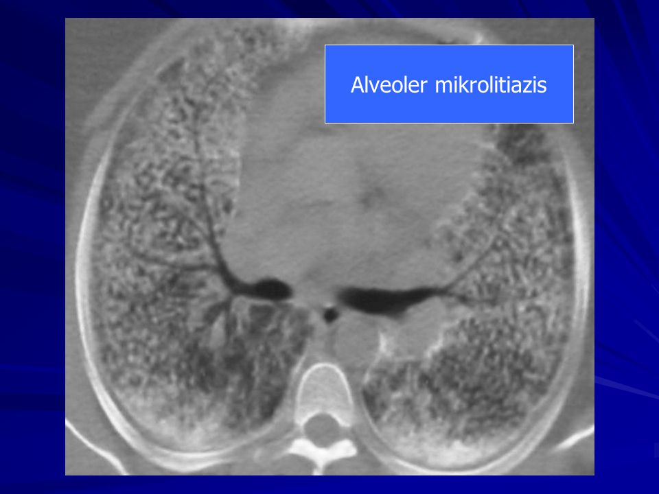 Alveoler mikrolitiazis