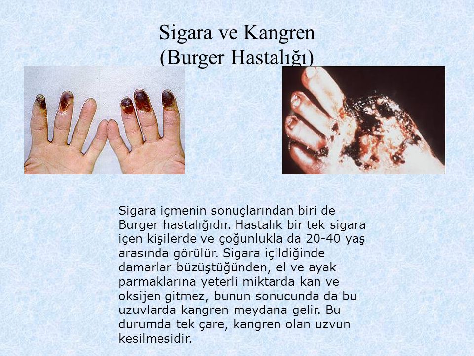 Sigara ve Kangren (Burger Hastalığı)