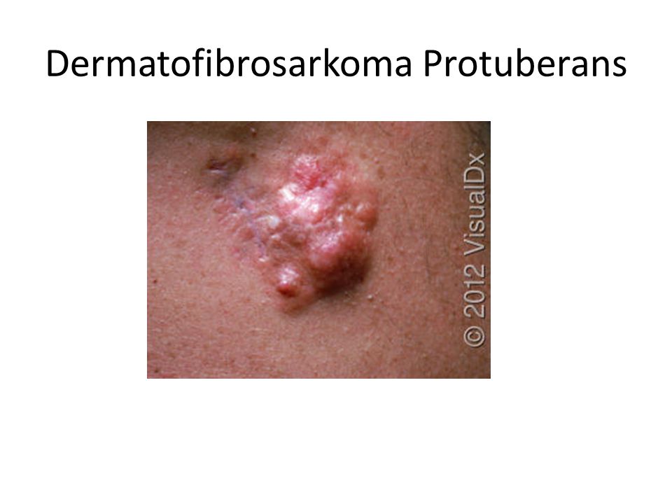 Dermatofibrosarkoma Protuberans
