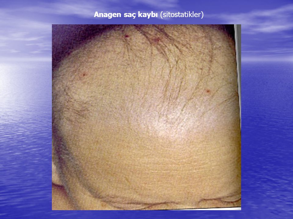 Anagen saç kaybı (sitostatikler)