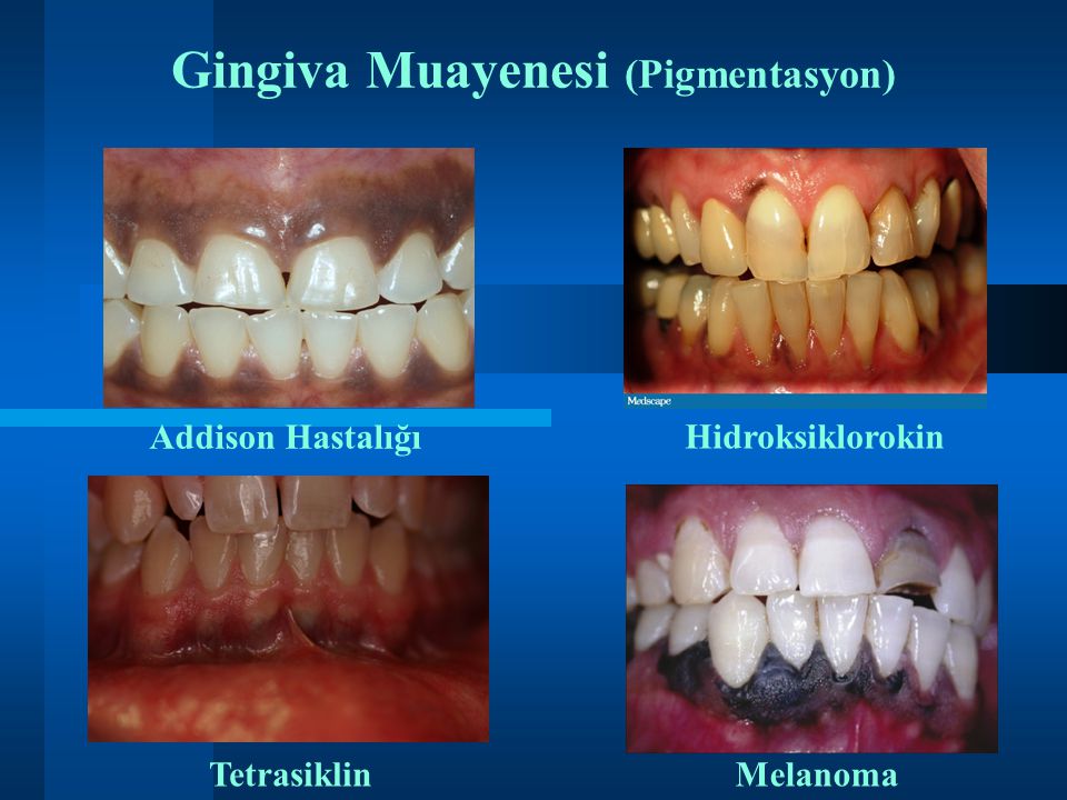Gingiva Muayenesi (Pigmentasyon)