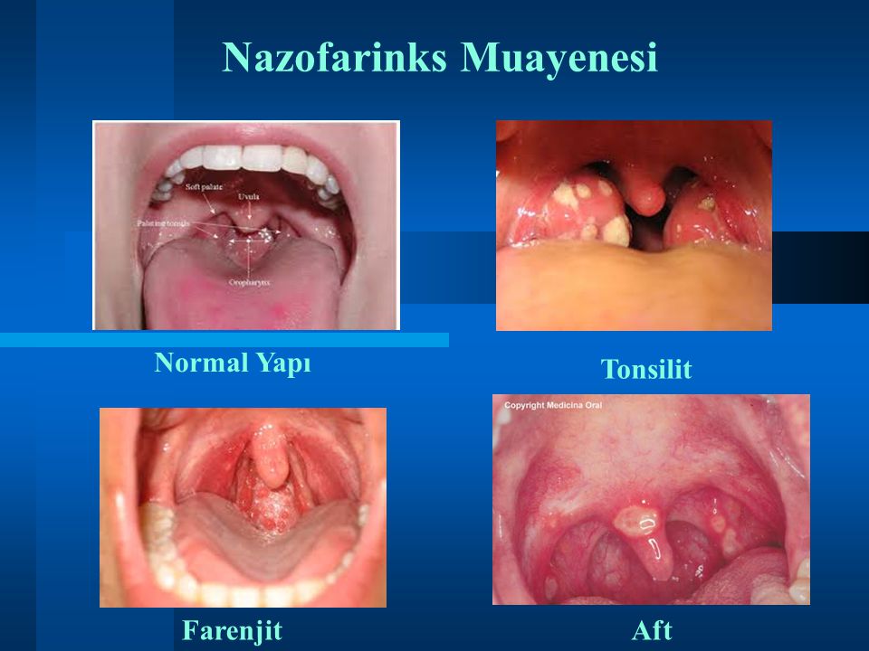 Nazofarinks Muayenesi