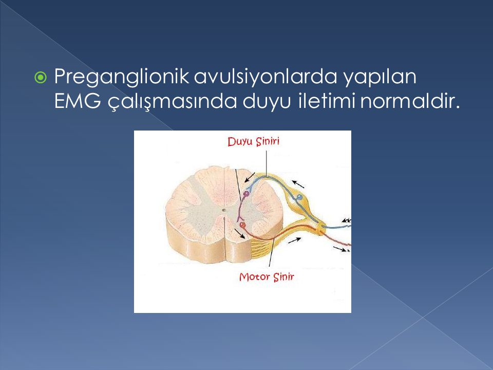 Preganglionik avulsiyonlarda yapılan EMG çalışmasında duyu iletimi normaldir.