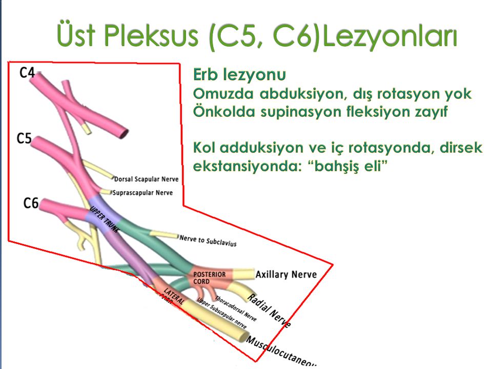 Üst Pleksus (C5, C6)Lezyonları