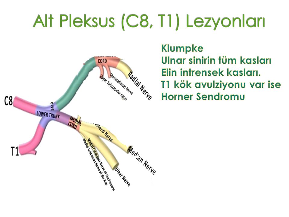 Alt Pleksus (C8, T1) Lezyonları