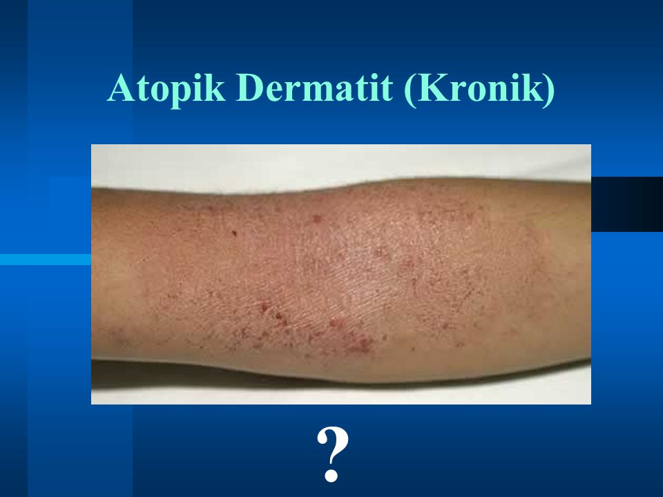 Atopik Dermatit (Kronik)