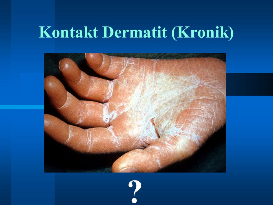 Kontakt Dermatit (Kronik)