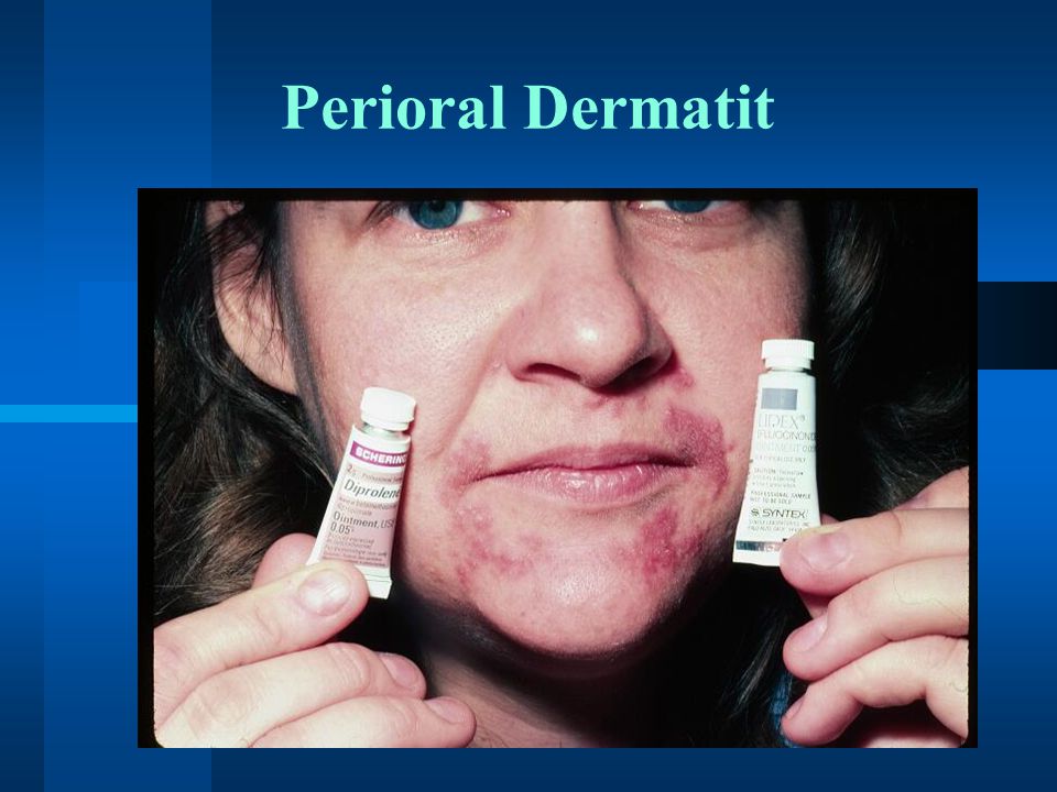 Perioral Dermatit
