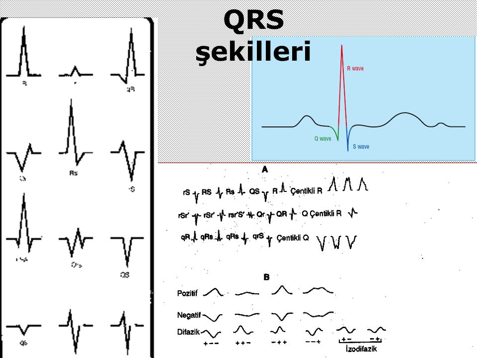 QRS şekilleri