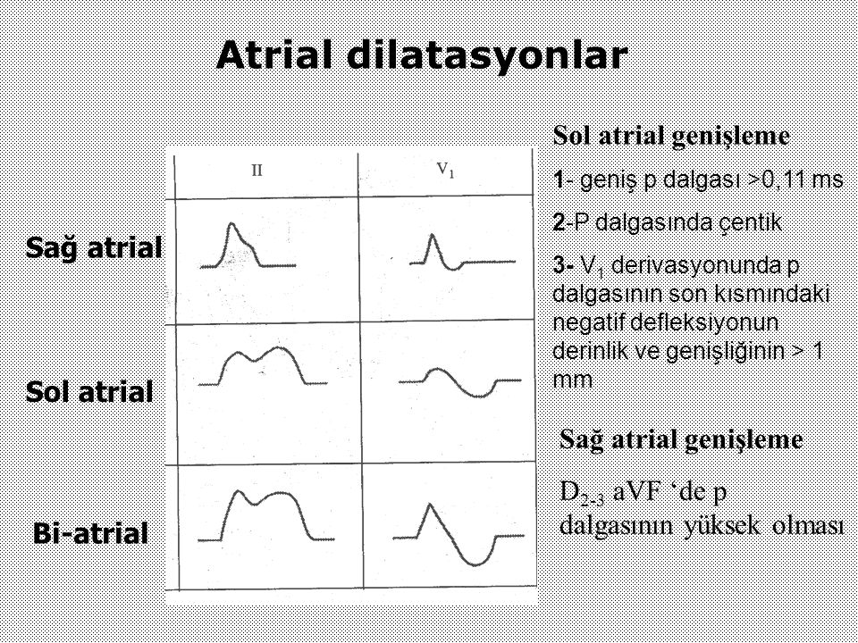 Atrial dilatasyonlar Sol atrial genişleme Sağ atrial Sol atrial