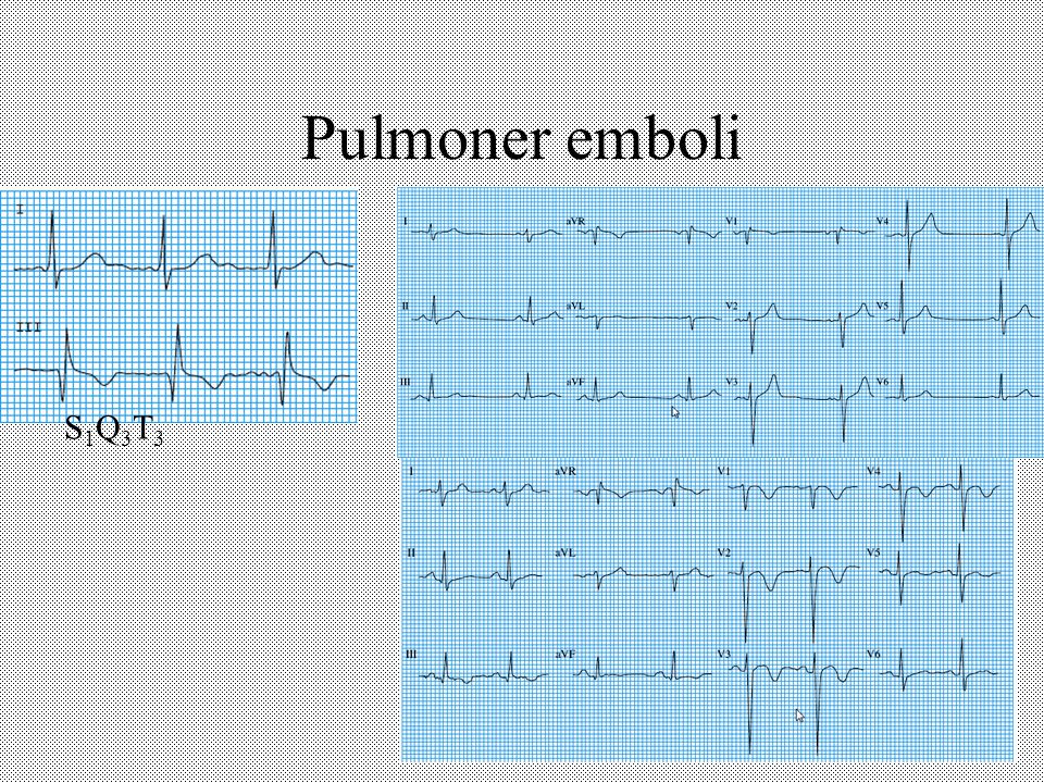 Pulmoner emboli S1Q3T3