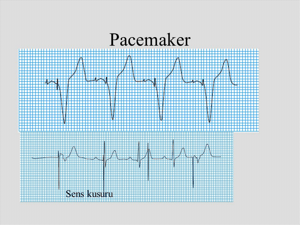Pacemaker Sens kusuru