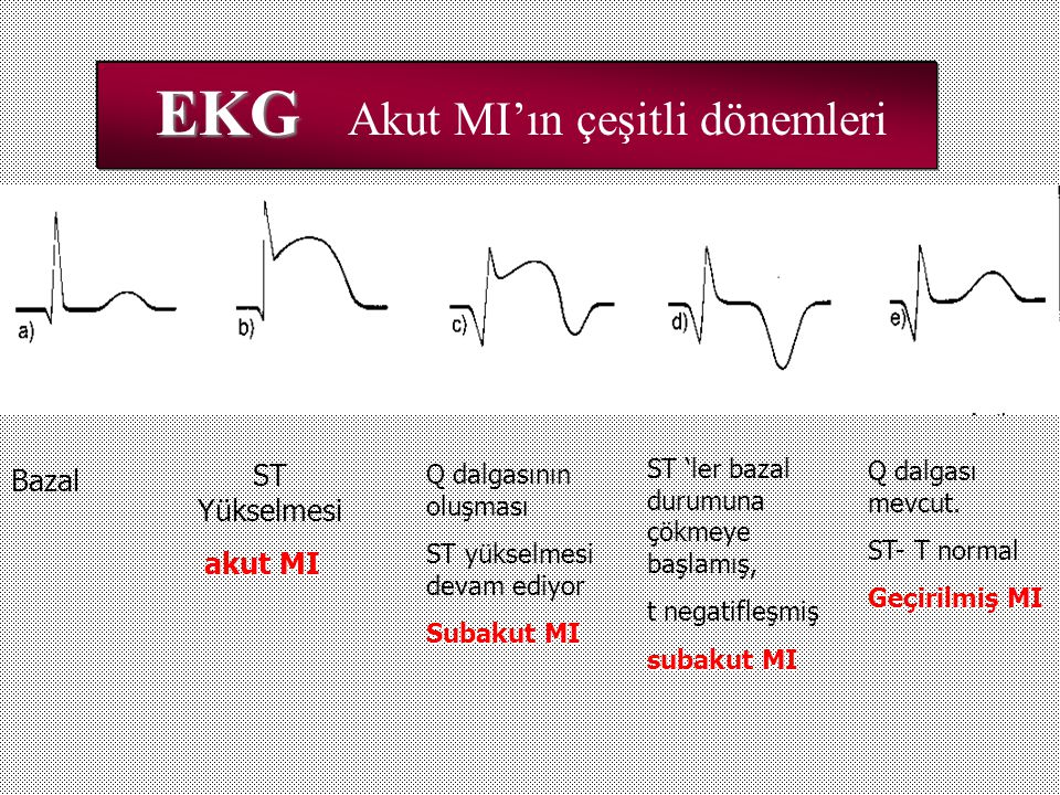 EKG Akut MI’ın çeşitli dönemleri