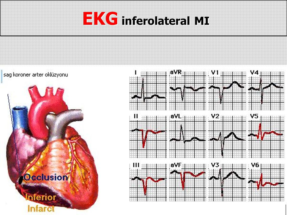 EKG inferolateral MI