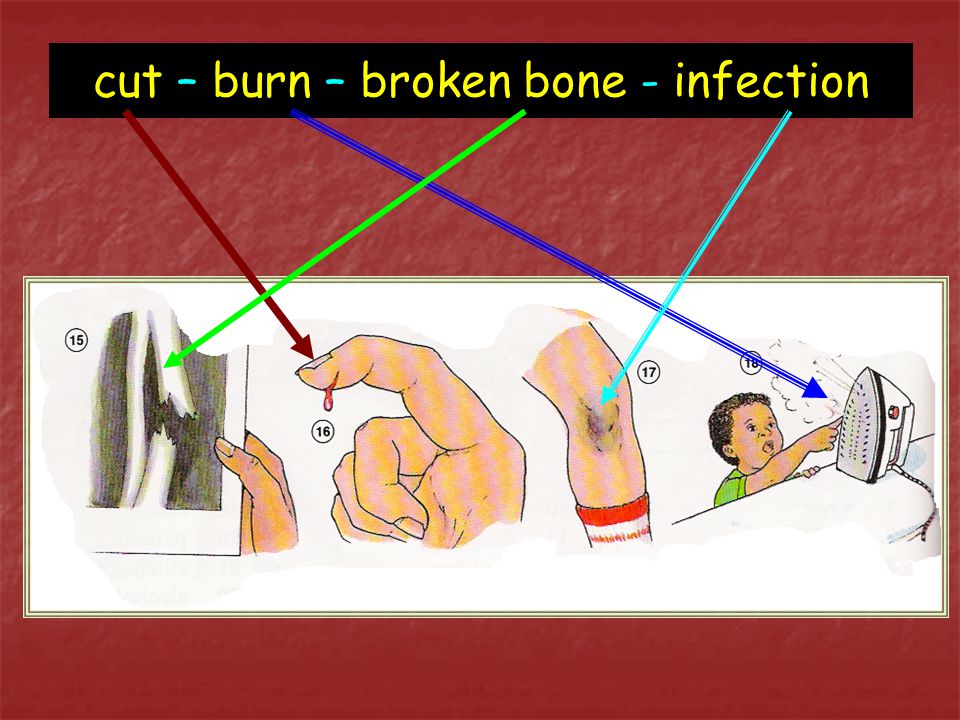 cut – burn – broken bone - infection