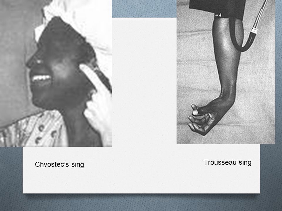 Trousseau sing Chvostec’s sing