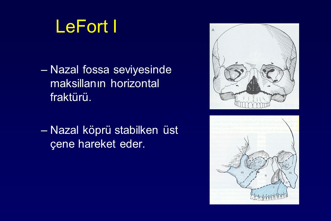 LeFort I Nazal fossa seviyesinde maksillanın horizontal fraktürü.