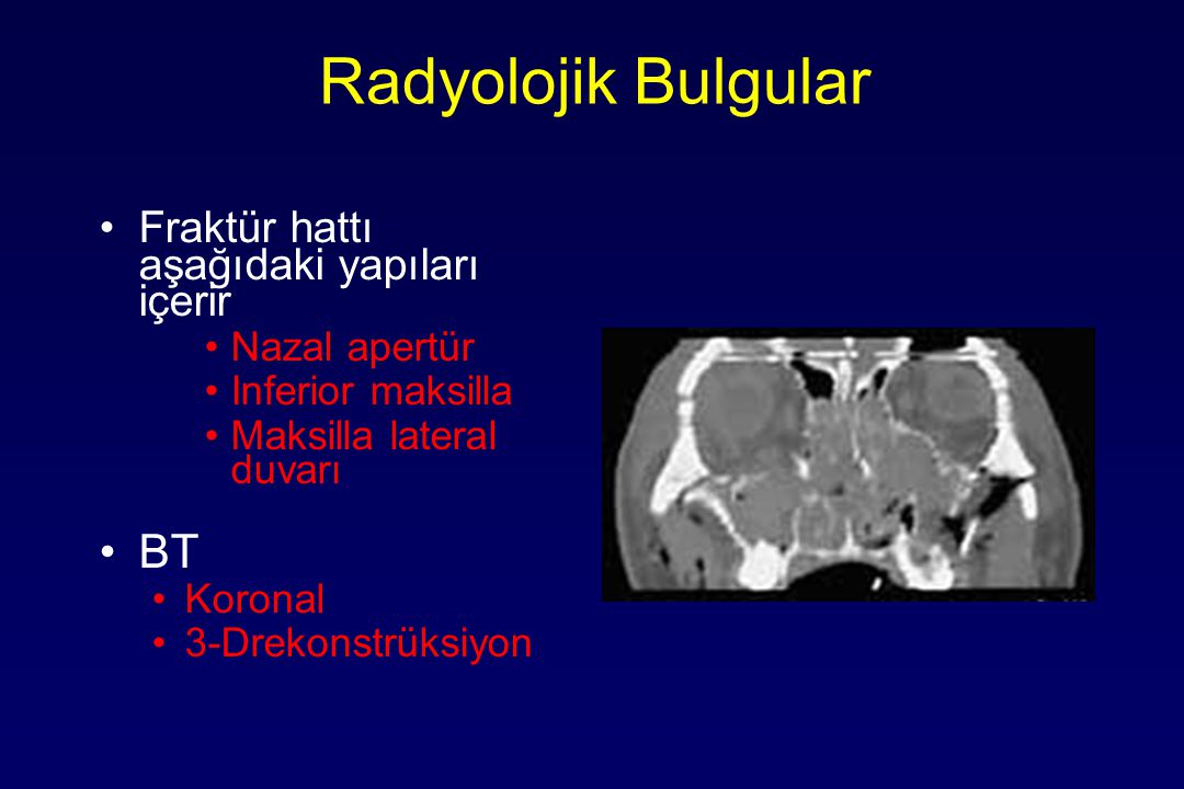 Radyolojik Bulgular BT Fraktür hattı aşağıdaki yapıları içerir
